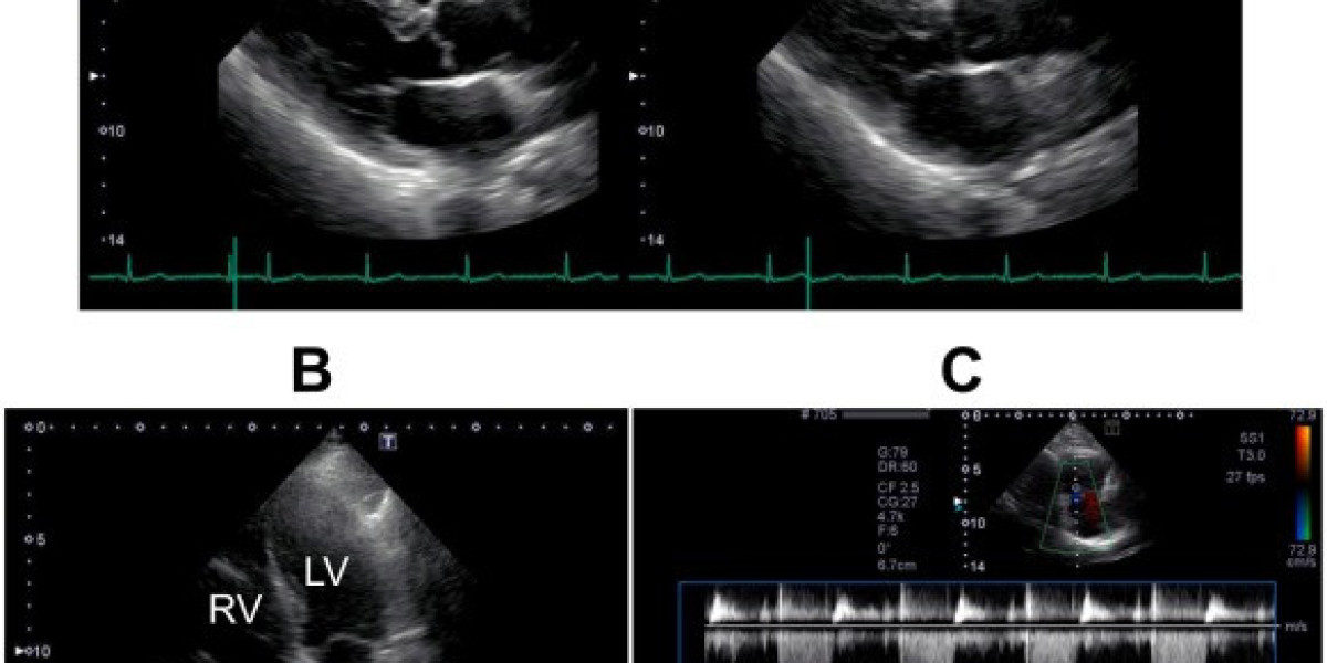 Carfilzomib-induced pulmonary hypertension in a patient with multiple myeloma